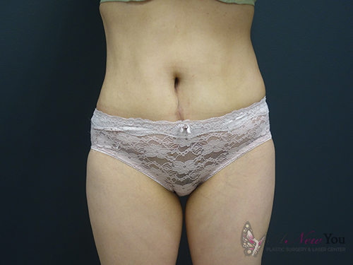 Tummy Tuck After - Chicago, IL