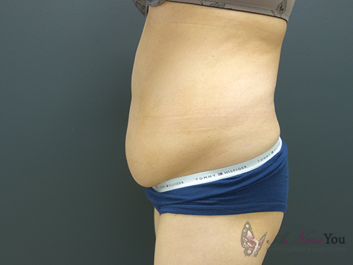 Tummy Tuck Before - Chicago, IL