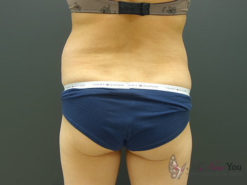 Tummy Tuck Before - Chicago, IL