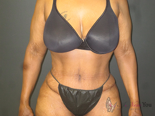 Tummy Tuck After - Chicago, IL