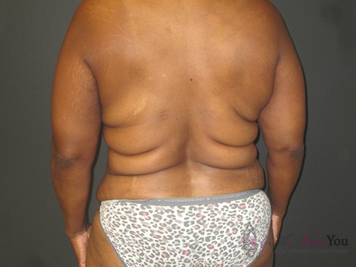 Tummy Tuck Before - Chicago, IL