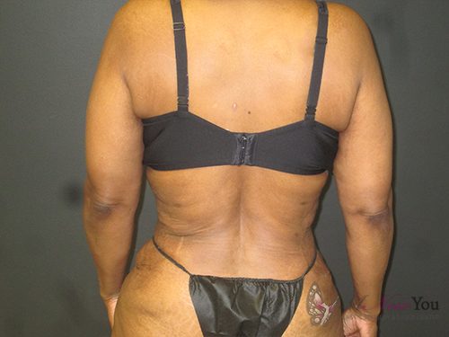 Tummy Tuck After - Chicago, IL