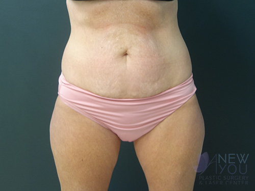 Tummy Tuck Before - Chicago, IL