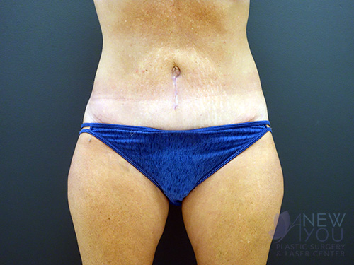 Tummy Tuck After - Chicago, IL