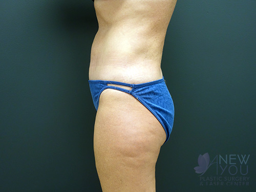 Tummy Tuck After - Chicago, IL