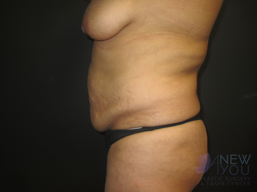 Tummy Tuck Before - Chicago, IL