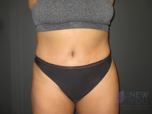 Tummy Tuck After - Chicago, IL