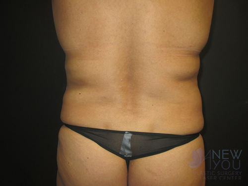 Tummy Tuck Before - Chicago, IL