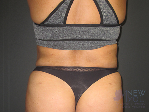 Tummy Tuck After - Chicago, IL