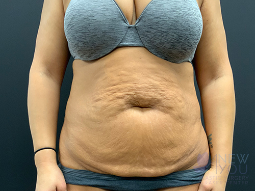 Tummy Tuck Before - Chicago, IL