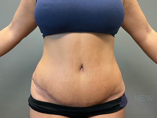 Tummy Tuck After - Chicago, IL