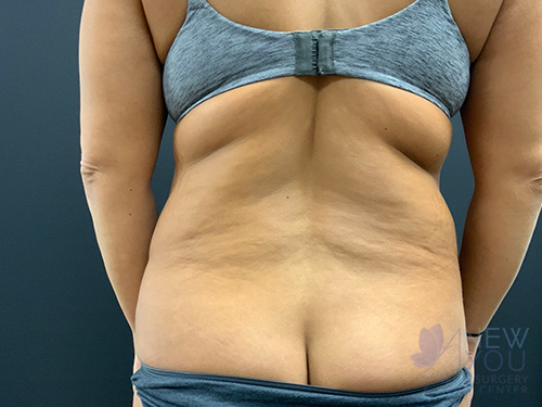 Tummy Tuck Before - Chicago, IL