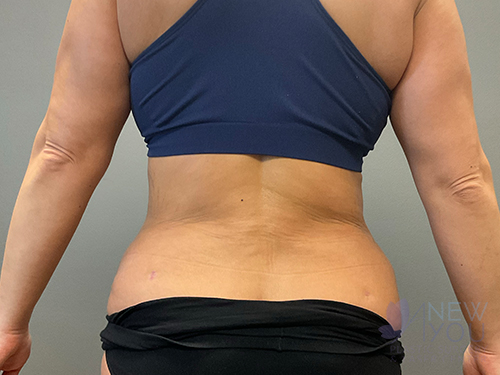 Tummy Tuck After - Chicago, IL