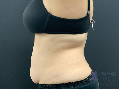 Tummy Tuck Before Tummy Tuck Before - Chicago, IL