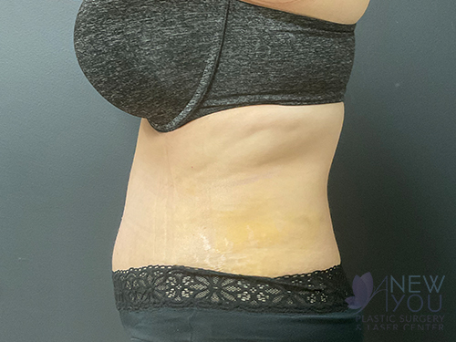 Tummy Tuck After Tummy Tuck After - Chicago, IL
