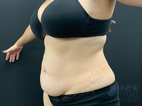 Tummy Tuck Before Tummy Tuck Before - Chicago, IL