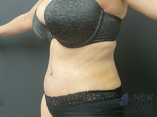 Tummy Tuck After Tummy Tuck After - Chicago, IL