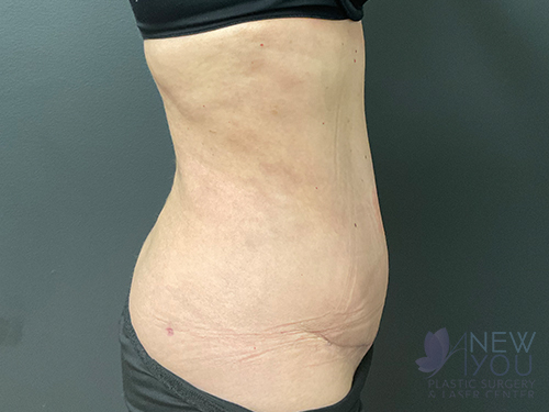 Tummy Tuck After - Chicago, IL