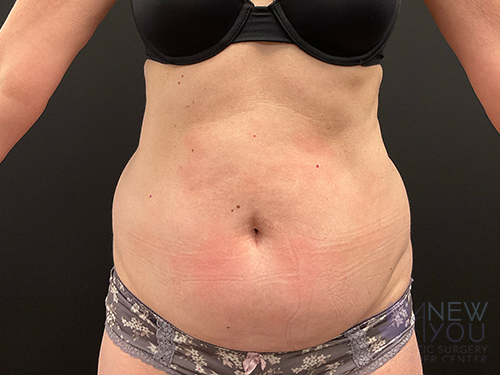 Tummy Tuck Before - Chicago, IL