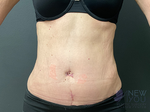 Tummy Tuck After - Chicago, IL