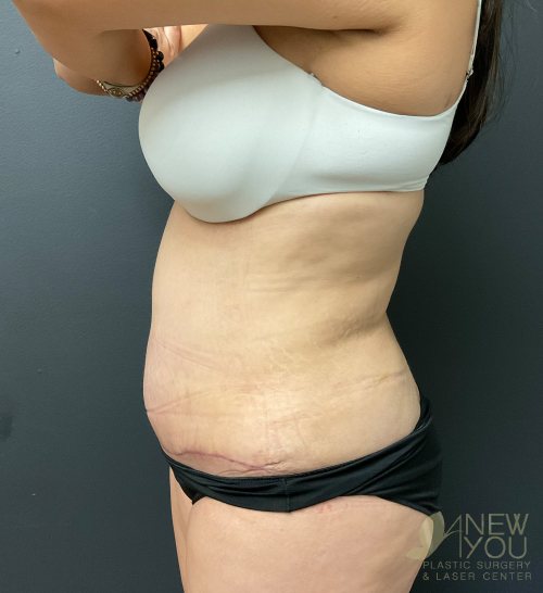 Tummy Tuck After - Chicago, IL