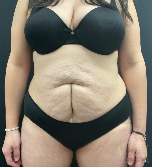 Tummy Tuck Before - Chicago, IL