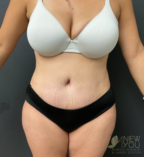 Tummy Tuck After - Chicago, IL