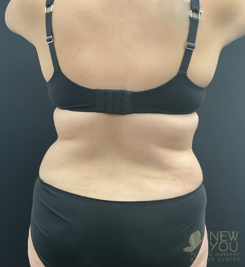 Tummy Tuck Before Tummy Tuck Before - Chicago, IL