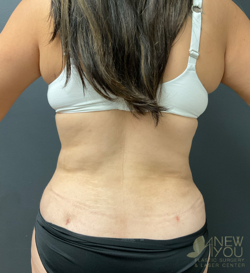 Tummy Tuck After Tummy Tuck After - Chicago, IL