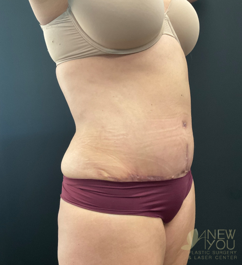 Tummy Tuck After - Chicago, IL