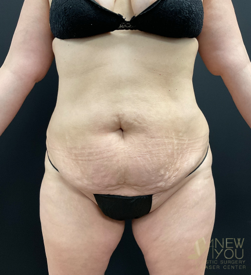 Tummy Tuck Before Tummy Tuck Before - Chicago, IL