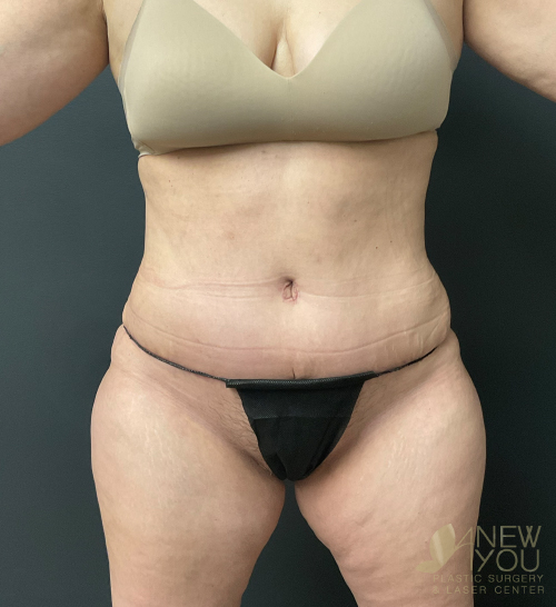 Tummy Tuck After - Chicago, IL